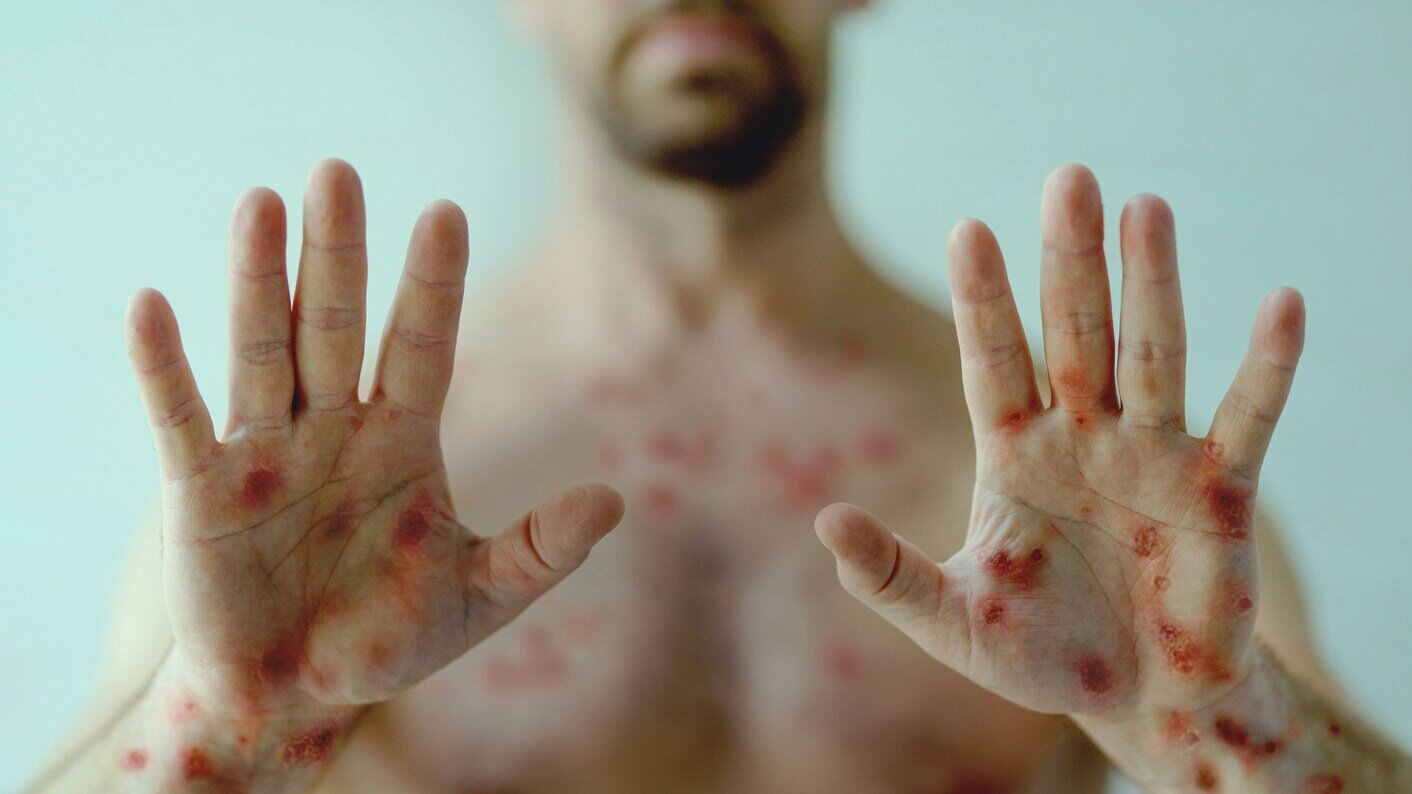 Scabies hero image